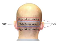 Diagram showing the permanent donor zone on a scalp